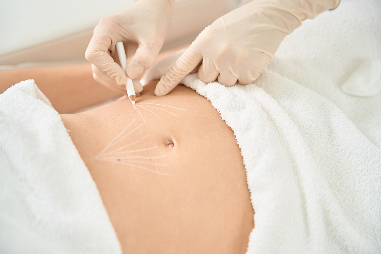 liposukcija