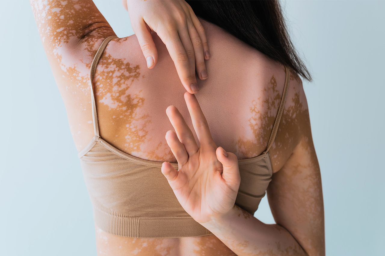 Vitiligo nije zarazan - to je posledica gubitka pigmenta kože | MediGroup