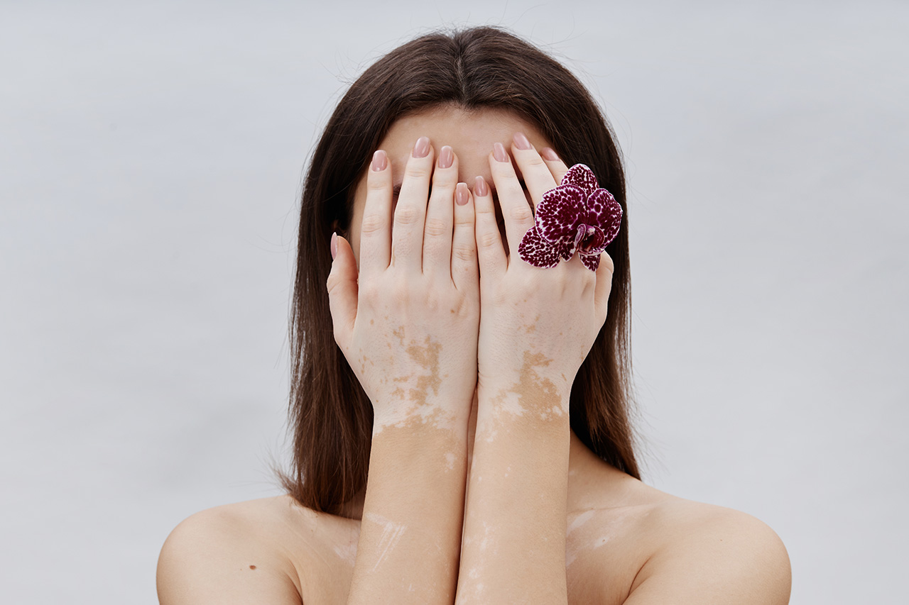 Vitiligo nije zarazan - to je posledica gubitka pigmenta kože | MediGroup