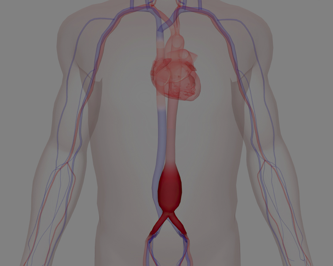 Aneurizma trbušne aorte - kako se aneurizma otkriva? | MediGroup